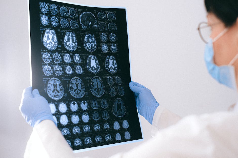 Brain scan showing abnormalities associated with Frontotemporal Dementia